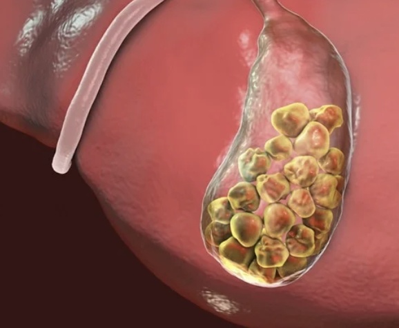 Lithiase biliaire