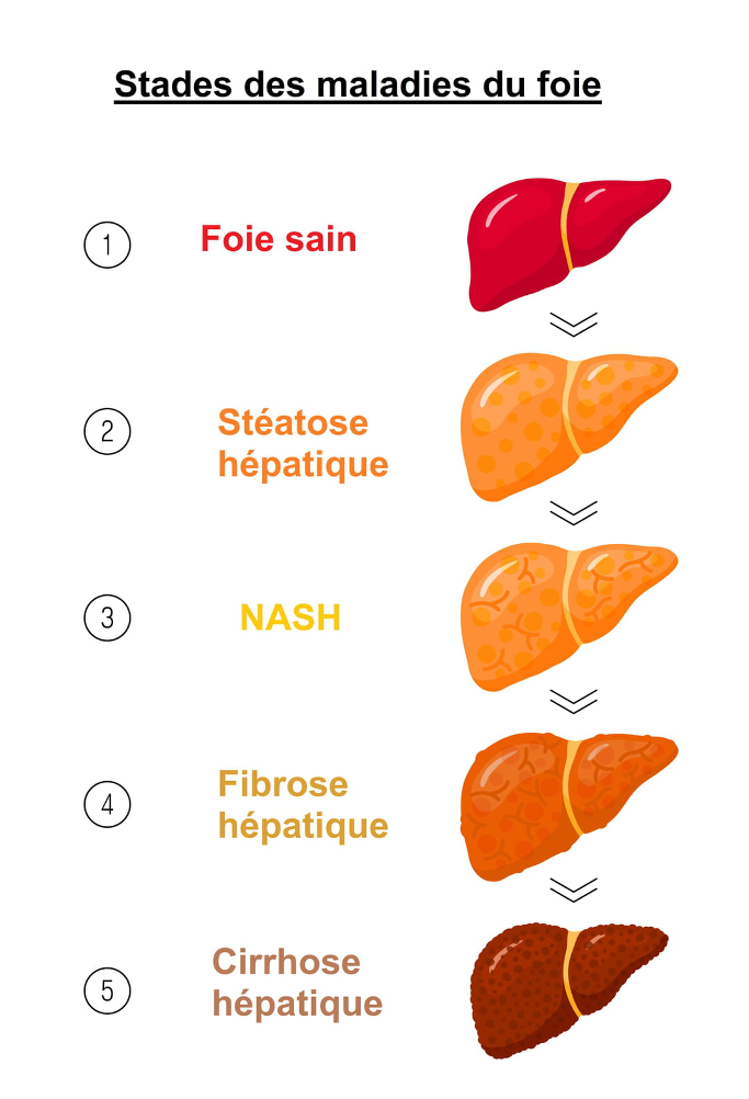 Stades des maladies du fois gastroenterologue Jules Verne